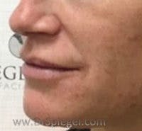 Lip Filler Before & After Gallery - Patient 113338 - Image 4