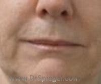 Lip Filler Before & After Gallery - Patient 643599 - Image 1