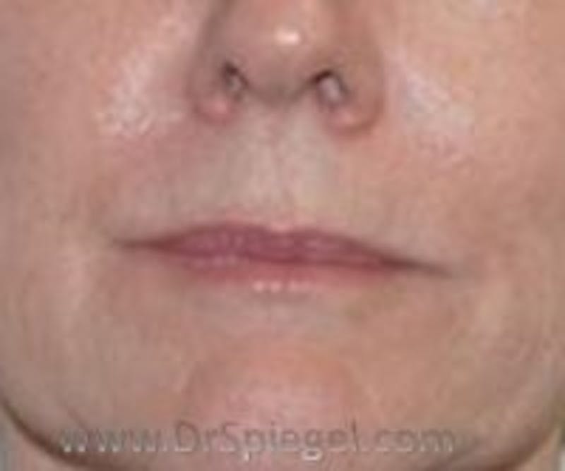 Lip Filler Before & After Gallery - Patient 643599 - Image 2