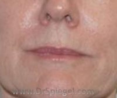 Lip Filler Before & After Gallery - Patient 643599 - Image 2