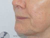 Lip Filler Before & After Gallery - Patient 643599 - Image 3