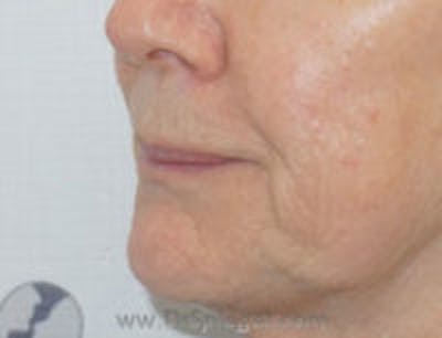 Lip Filler Before & After Gallery - Patient 643599 - Image 3