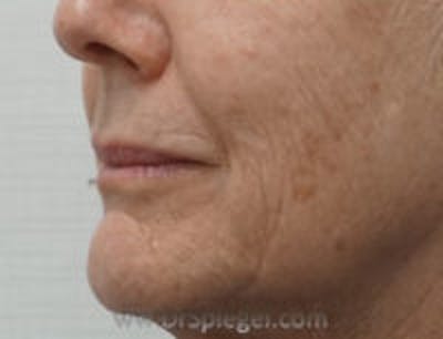 Lip Filler Before & After Gallery - Patient 643599 - Image 4