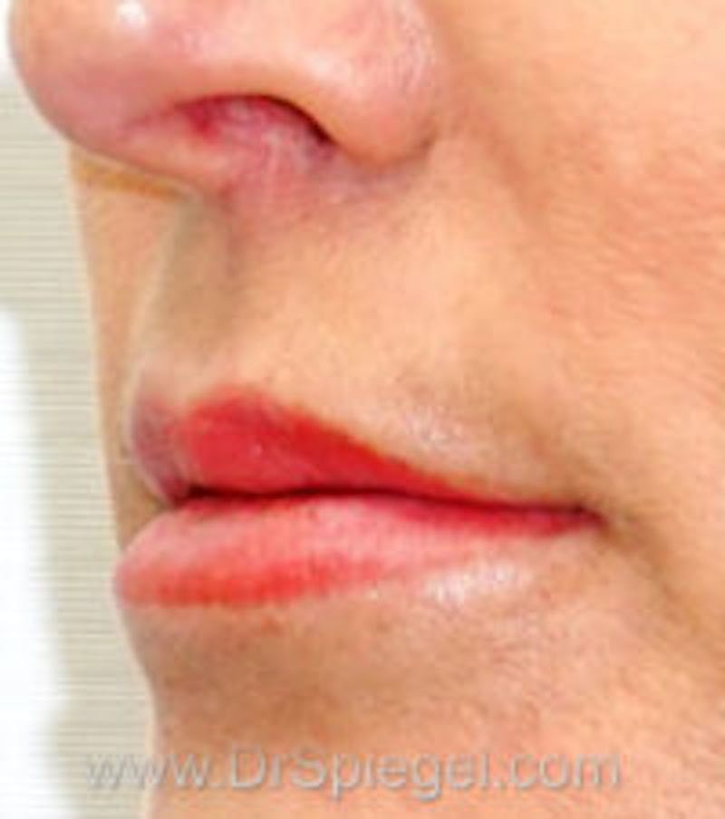 Lip Filler Before & After Gallery - Patient 704300 - Image 1