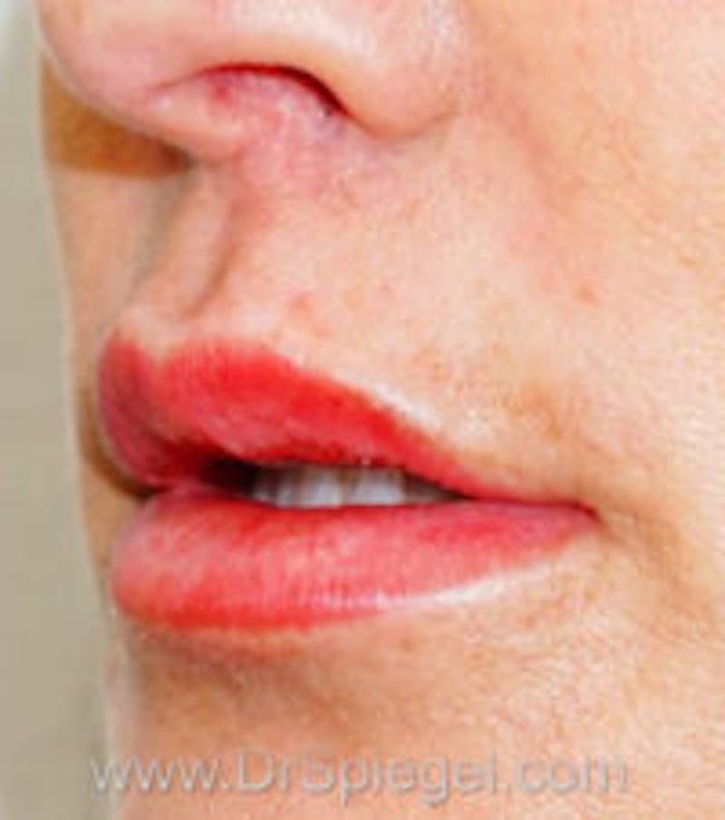 Lip Filler Before & After Gallery - Patient 704300 - Image 2