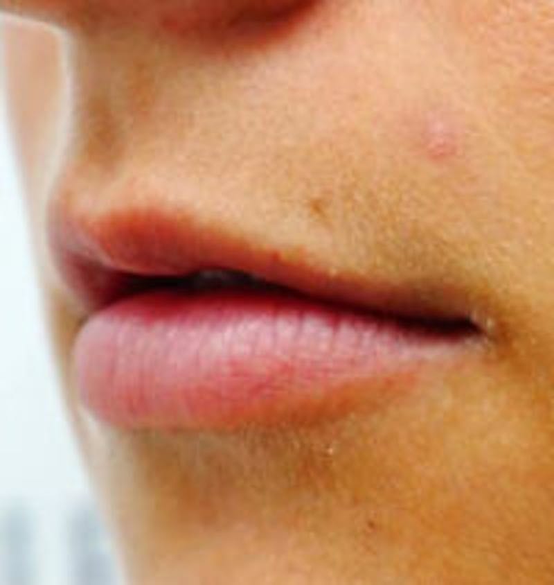 Lip Filler Before & After Gallery - Patient 293748 - Image 1