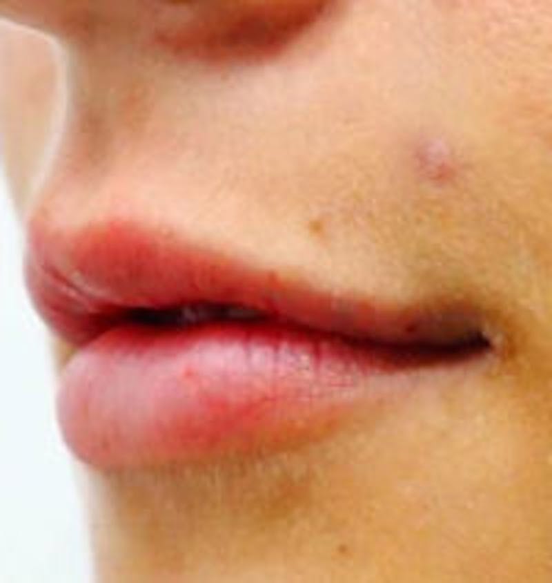 Lip Filler Before & After Gallery - Patient 293748 - Image 2