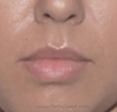 Lip Filler Before & After Gallery - Patient 181277 - Image 1