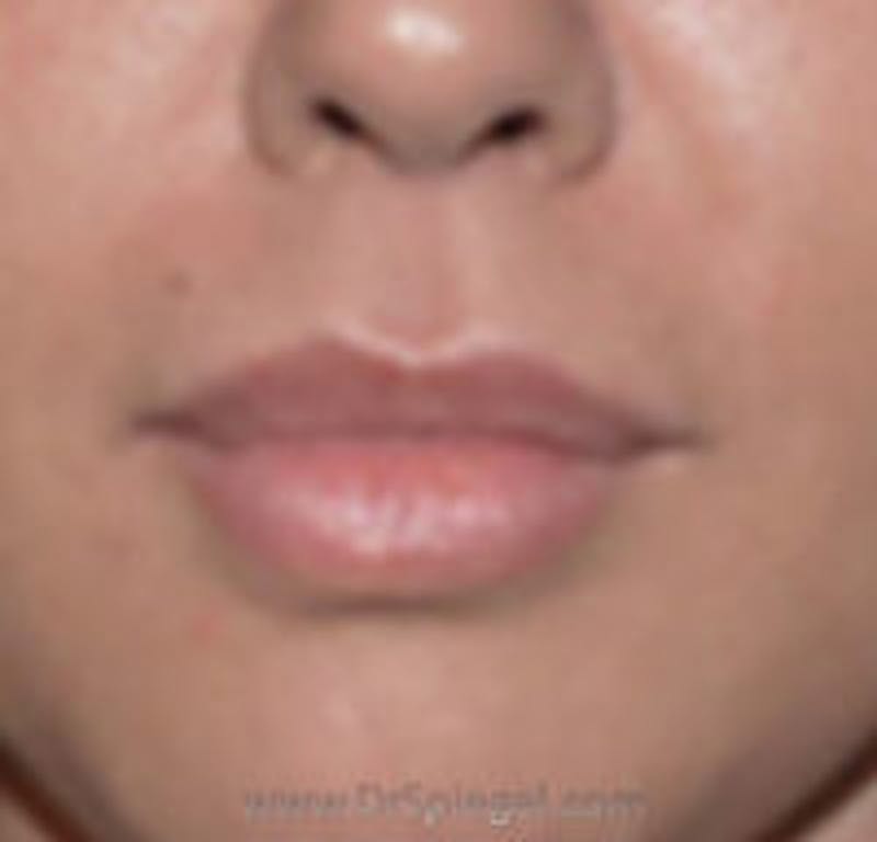 Lip Filler Before & After Gallery - Patient 181277 - Image 2