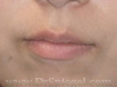 Lip Filler Before & After Gallery - Patient 210906 - Image 1