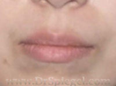 Lip Filler Before & After Gallery - Patient 210906 - Image 2