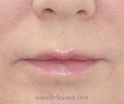 Lip Filler Before & After Gallery - Patient 309499 - Image 1
