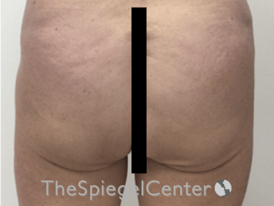 Liquid Butt Lift Before & After Gallery - Patient 636197 - Image 1