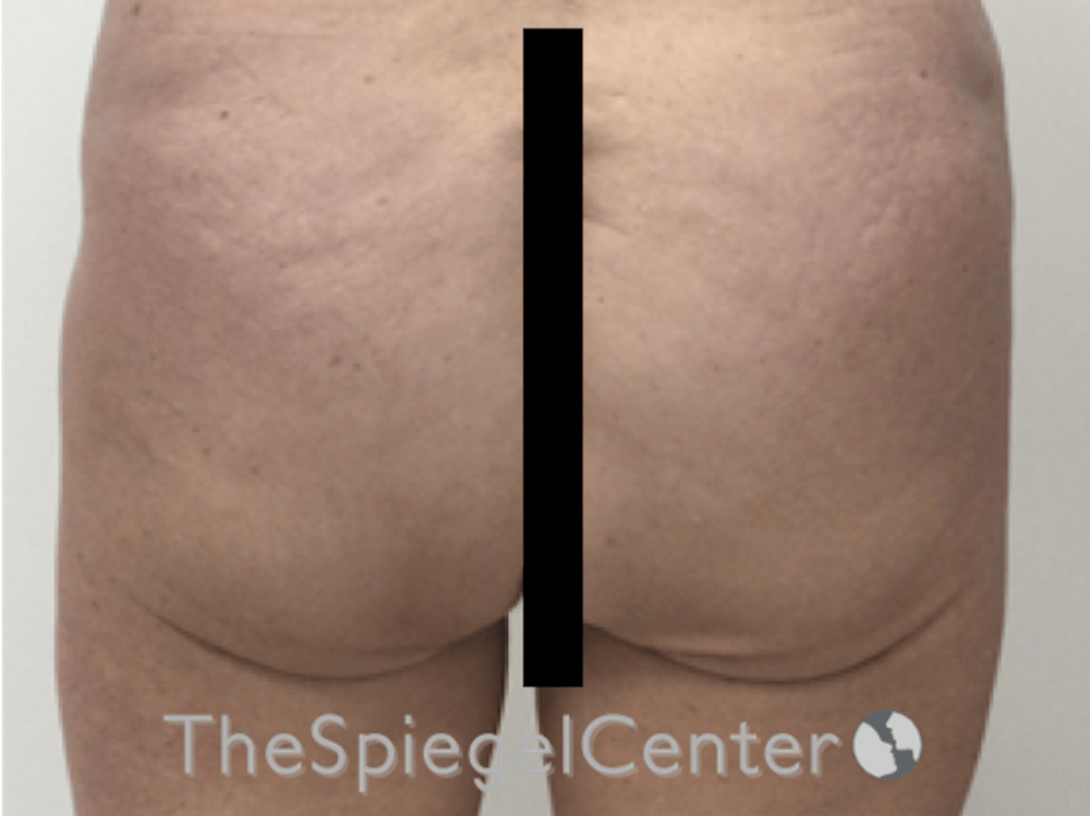 Non-Surgical Butt Lift