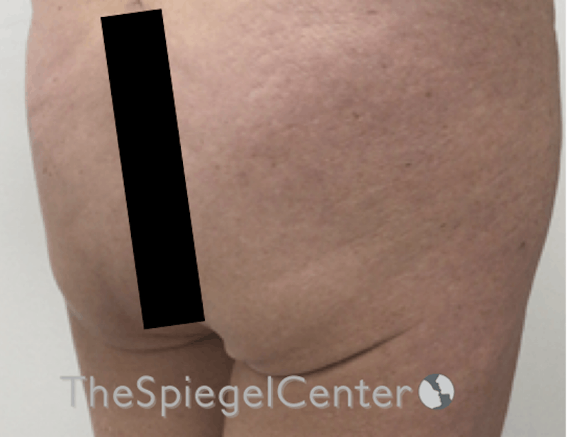 Liquid Butt Lift Before & After Gallery - Patient 636197 - Image 3