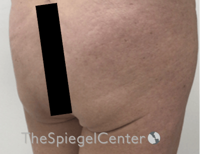 Liquid Butt Lift Before & After Gallery - Patient 636197 - Image 3