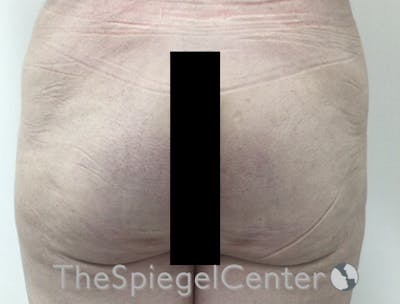 Liquid Butt Lift Before & After Gallery - Patient 422214 - Image 1