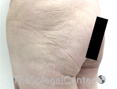 Liquid Butt Lift Before & After Gallery - Patient 422214 - Image 3