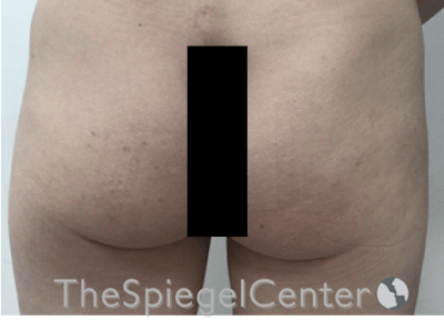 Liquid Butt Lift Before & After Gallery - Patient 257331 - Image 1