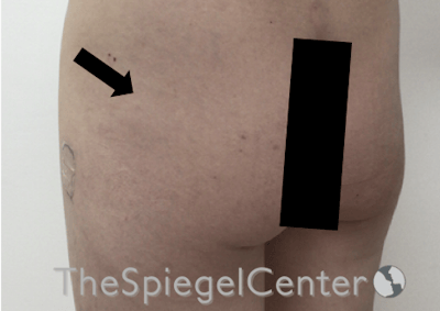 Liquid Butt Lift Before & After Gallery - Patient 257331 - Image 3