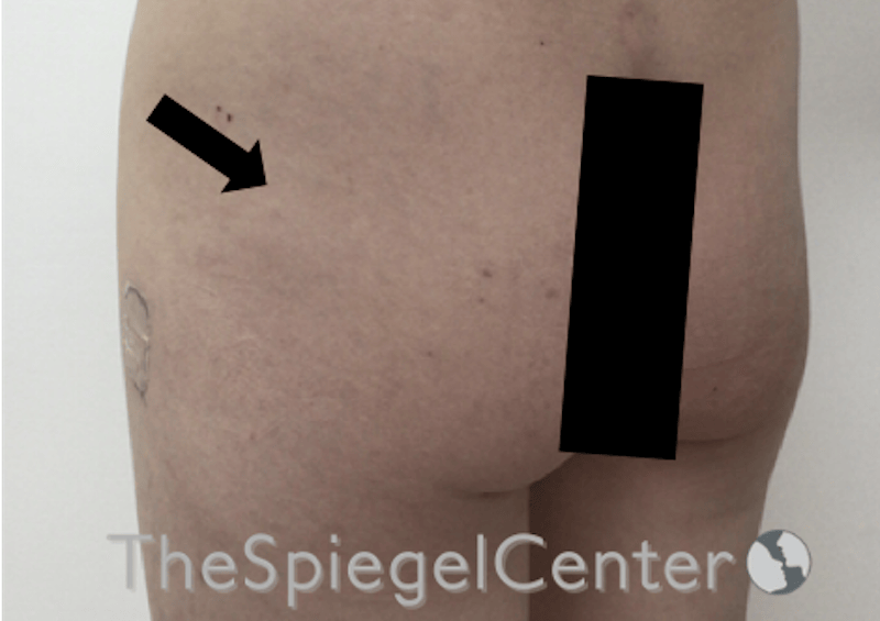 Liquid Butt Lift Before & After Gallery - Patient 257331 - Image 3