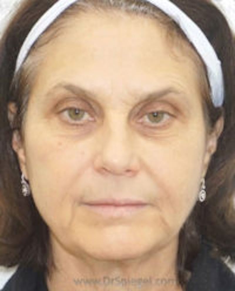 Liquid Face Lift Before & After Gallery - Patient 333142 - Image 2