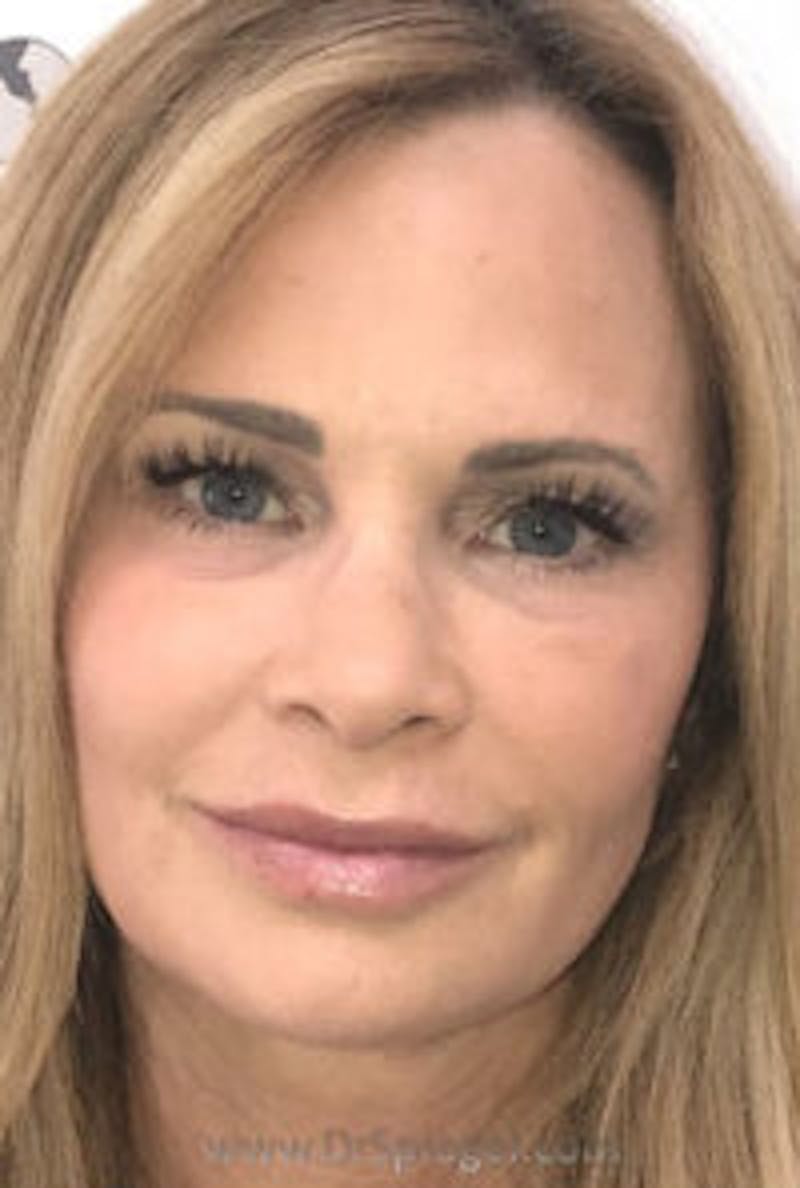 Liquid Face Lift Before & After Gallery - Patient 300768 - Image 2