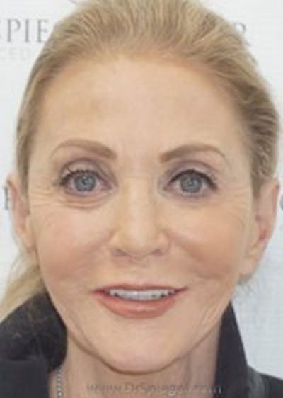 Liquid Face Lift Before & After Gallery - Patient 310521 - Image 2