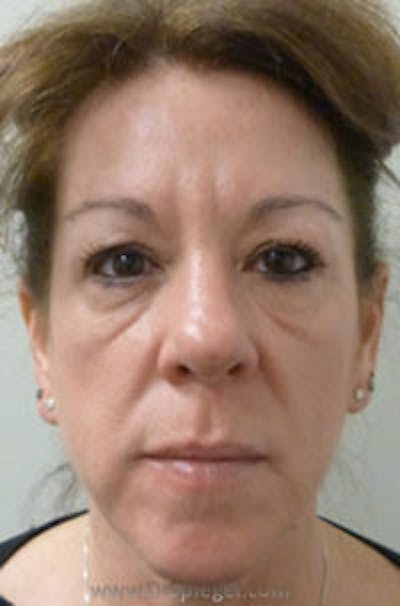 Liquid Face Lift Before & After Gallery - Patient 290217 - Image 1
