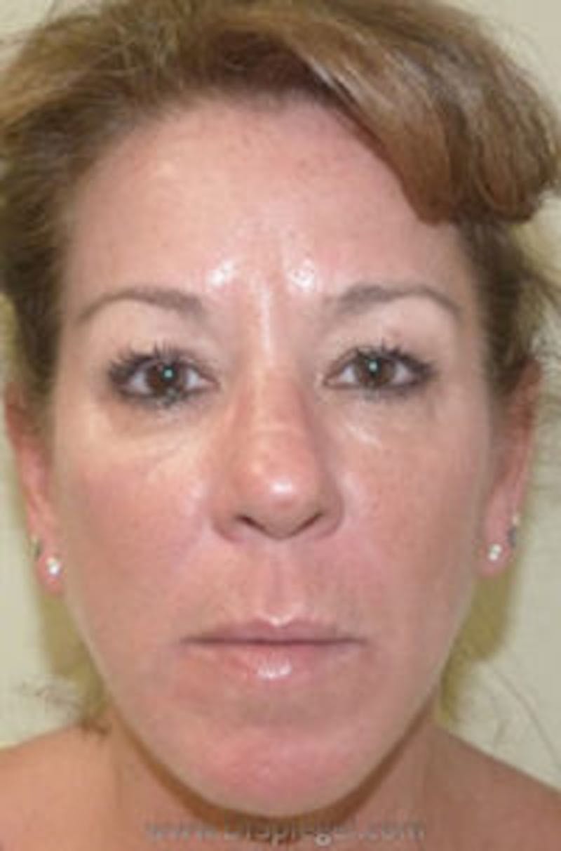 Liquid Face Lift Before & After Gallery - Patient 290217 - Image 2