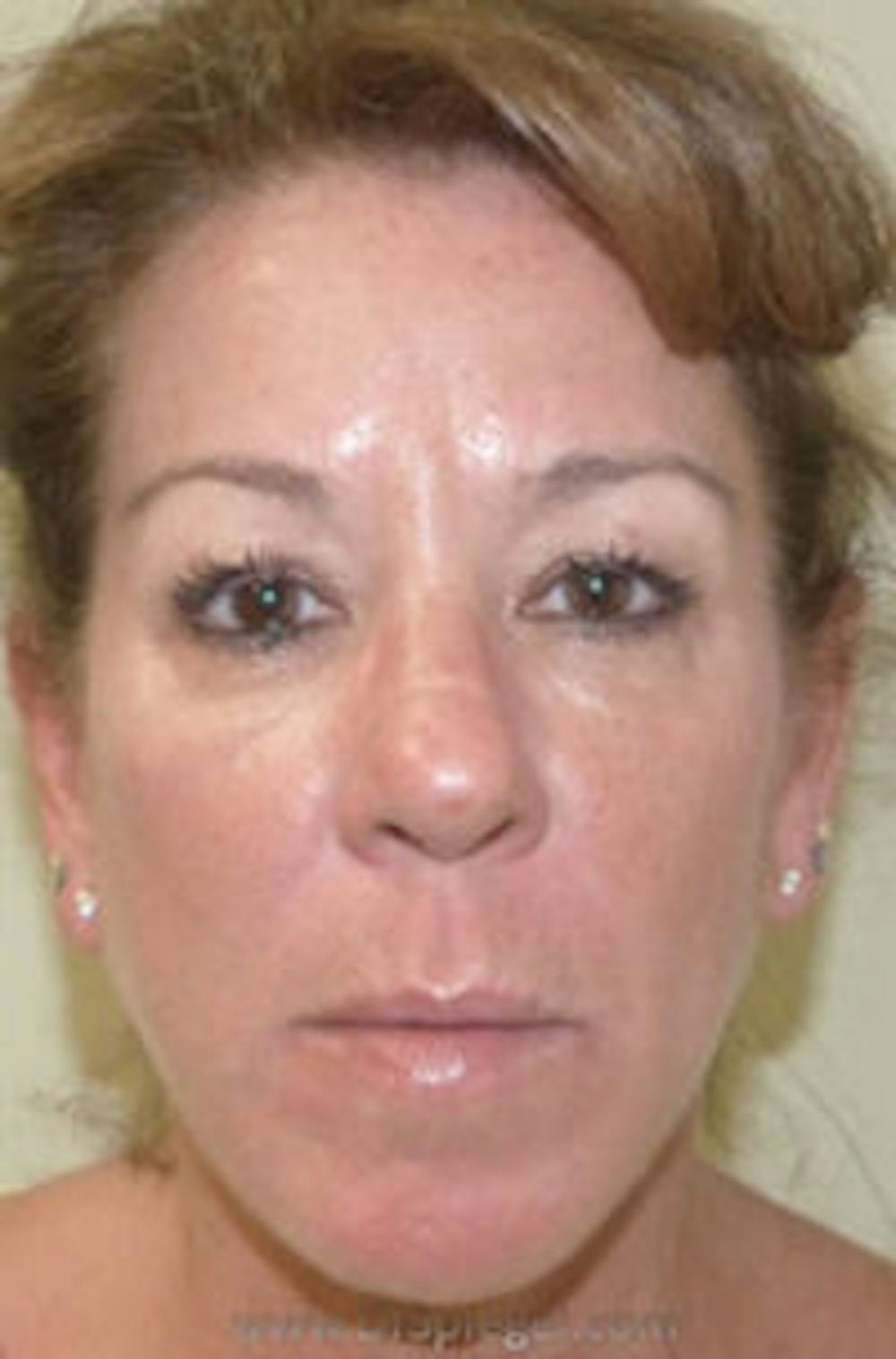 Dermal Fillers in Boston Before and After Photos