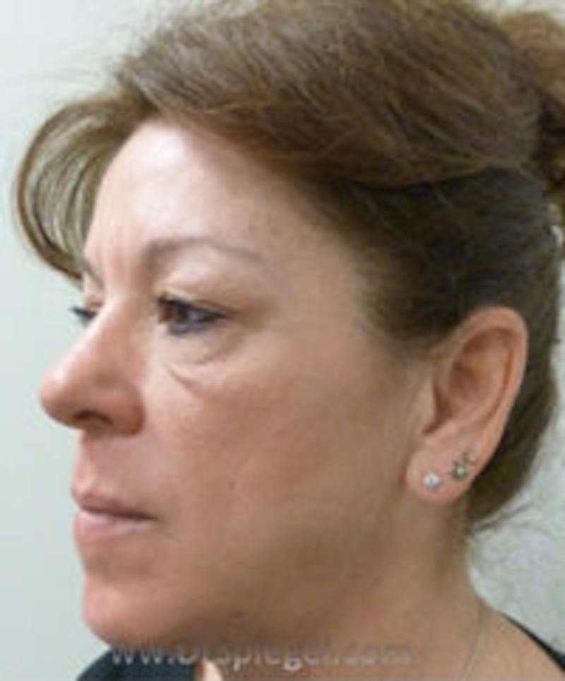 Liquid Face Lift Before & After Gallery - Patient 290217 - Image 3