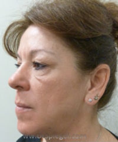 Liquid Face Lift Before & After Gallery - Patient 290217 - Image 3
