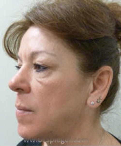 Liquid Face Lift Before & After Gallery - Patient 290217 - Image 3