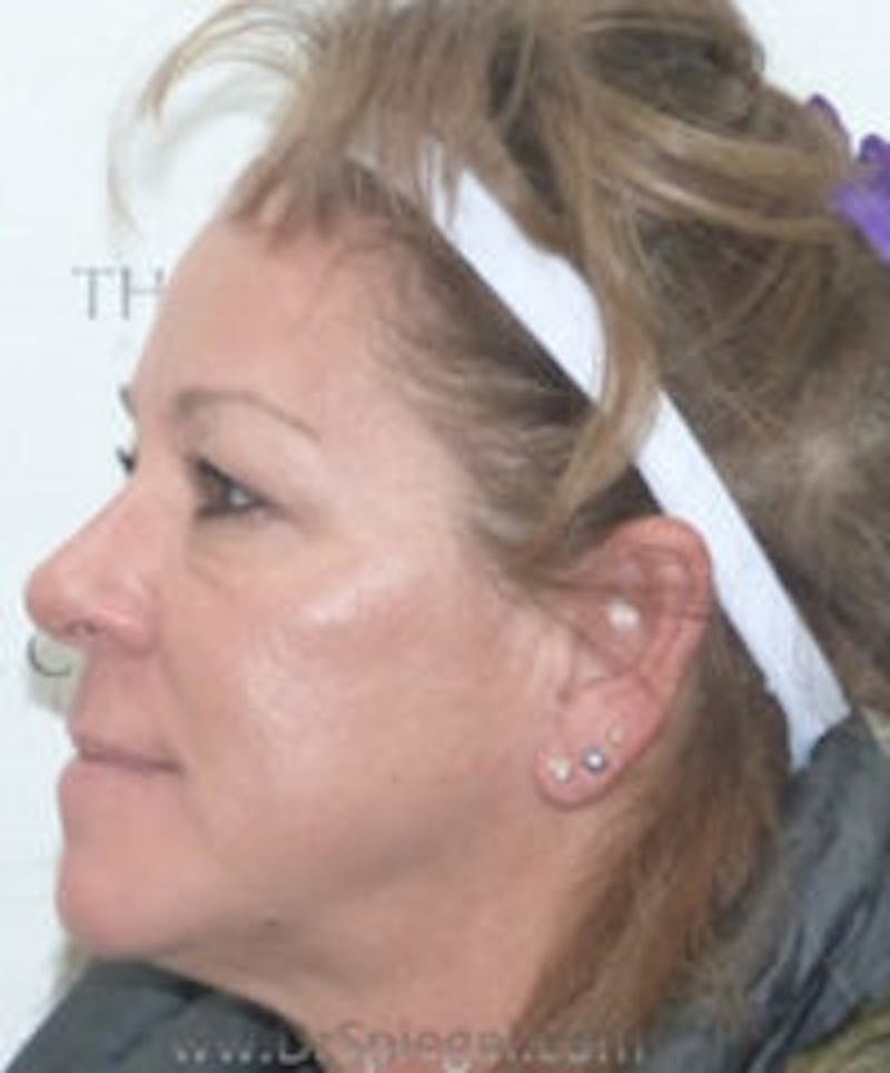 Liquid Face Lift Before & After Gallery - Patient 290217 - Image 4