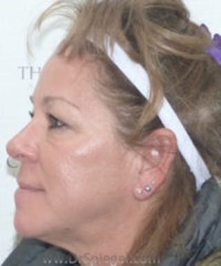 Liquid Face Lift Before & After Gallery - Patient 290217 - Image 4