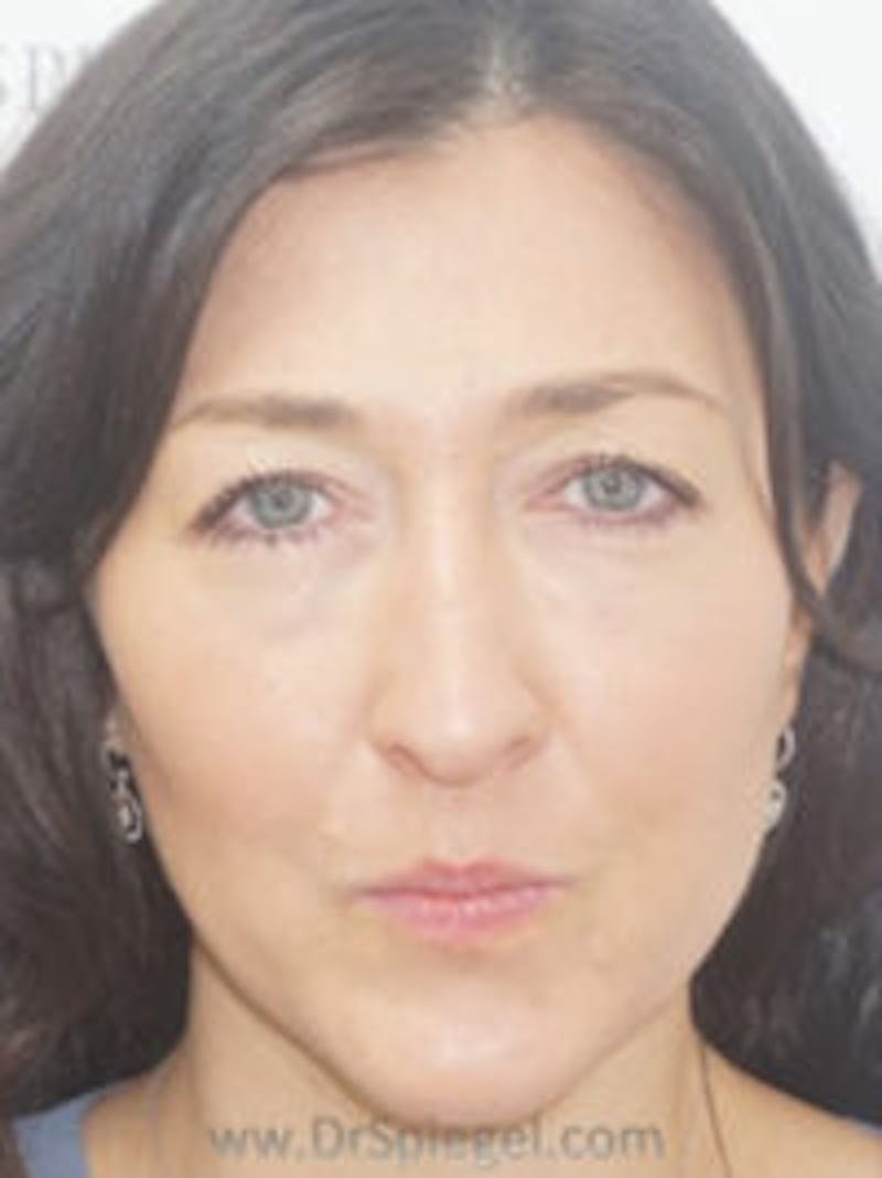 Liquid Face Lift Before & After Gallery - Patient 180211 - Image 1