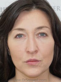 Liquid Face Lift Before & After Gallery - Patient 180211 - Image 2