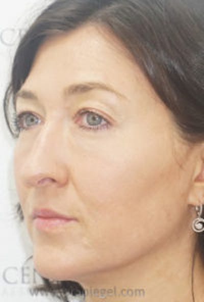 Liquid Face Lift Before & After Gallery - Patient 180211 - Image 3