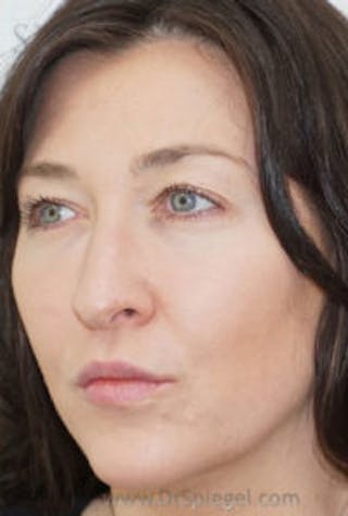 Liquid Face Lift Before & After Gallery - Patient 180211 - Image 4