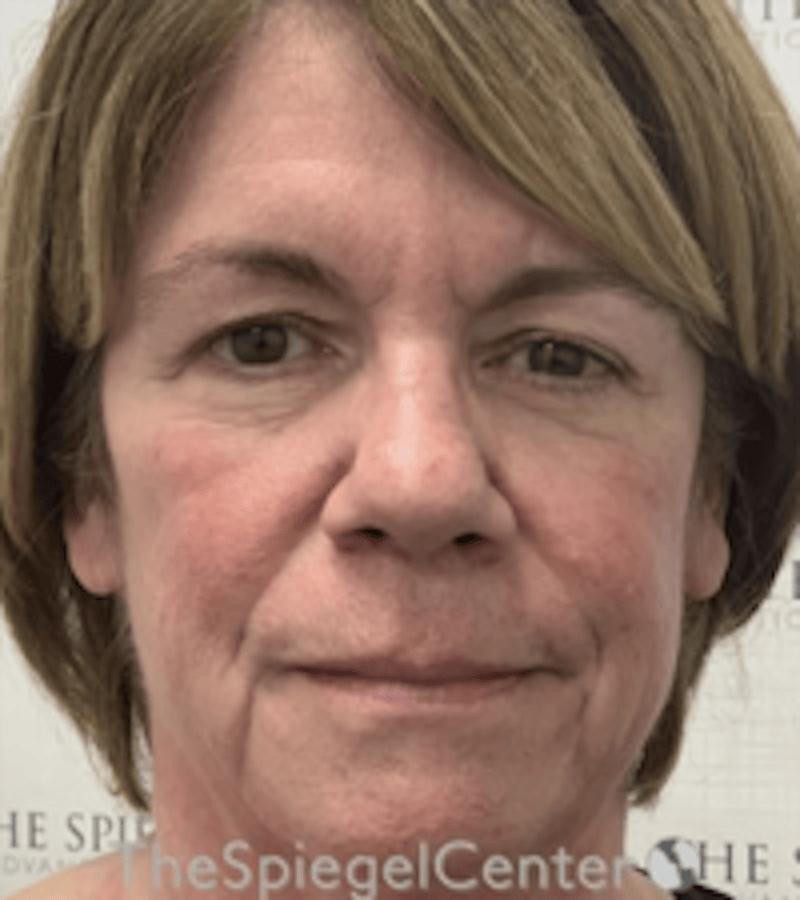 Liquid Face Lift Before & After Gallery - Patient 329691 - Image 1