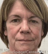 Liquid Face Lift Before & After Gallery - Patient 329691 - Image 1