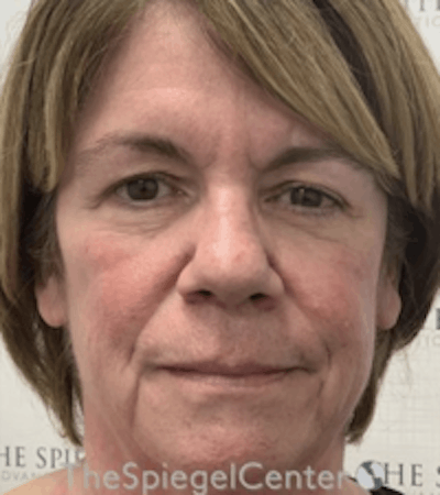 Liquid Face Lift Before & After Gallery - Patient 329691 - Image 1