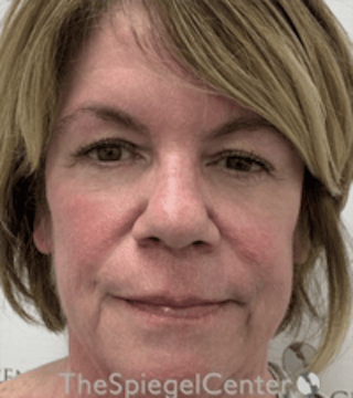 Liquid Face Lift Before & After Gallery - Patient 329691 - Image 2