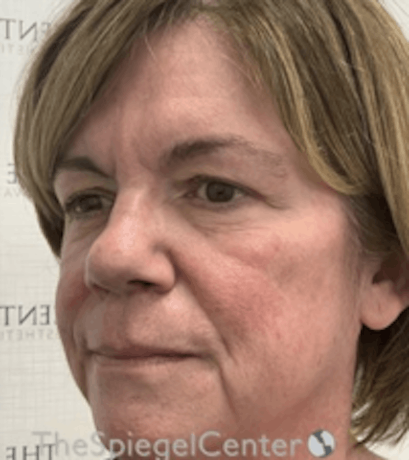 Liquid Face Lift Before & After Gallery - Patient 329691 - Image 3