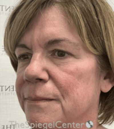 Liquid Face Lift Before & After Gallery - Patient 329691 - Image 3