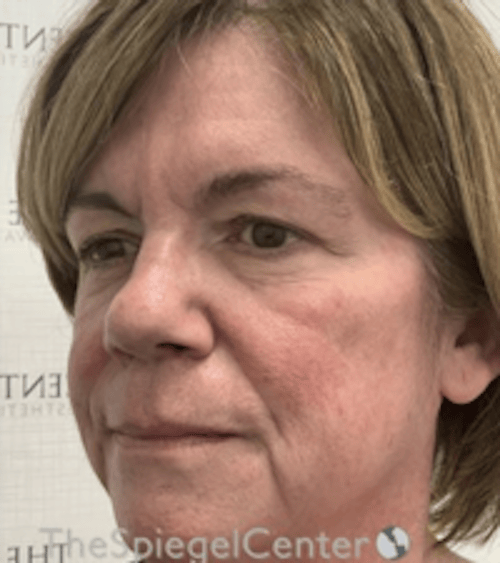 Liquid Face Lift Before & After Gallery - Patient 329691 - Image 3
