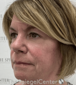 Liquid Face Lift Before & After Gallery - Patient 329691 - Image 4