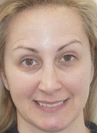 Liquid Face Lift Before & After Gallery - Patient 683280 - Image 1