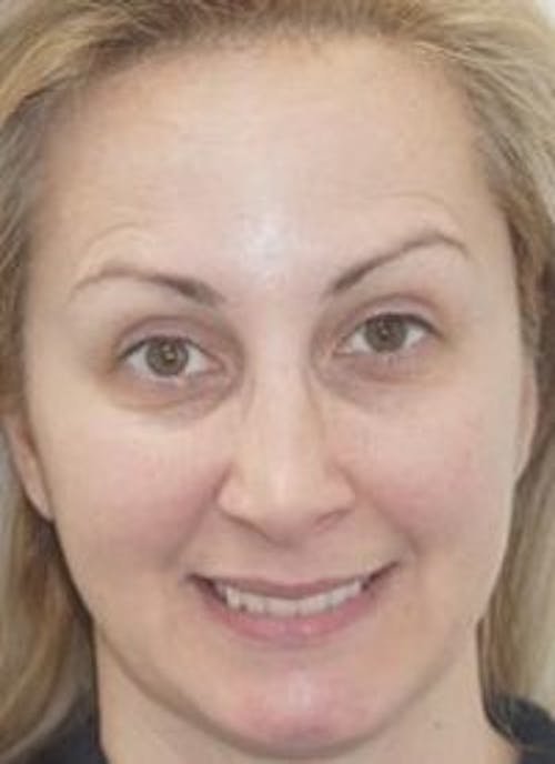 Liquid Face Lift Before & After Gallery - Patient 683280 - Image 1